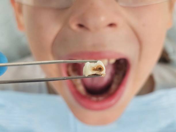 Best Chipped Tooth Repair Near Me  in Mansura, LA